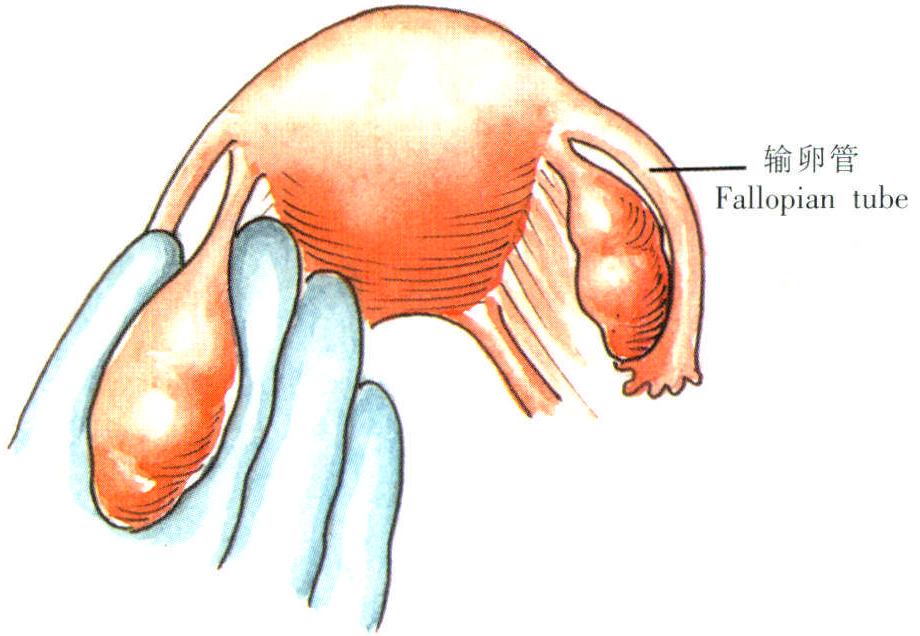 卵巢楔形切除术